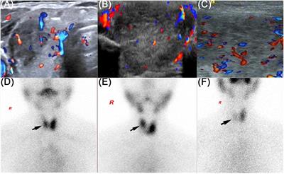 Case report: subacute thyroiditis after receiving SARS-CoV-2 vaccine, maybe not only adjuvants